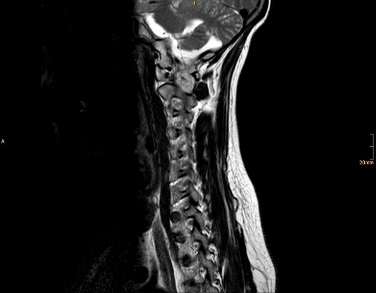 File:Arachnoid cyst - spinal (Radiopaedia 10055-10597 T2 9).jpg
