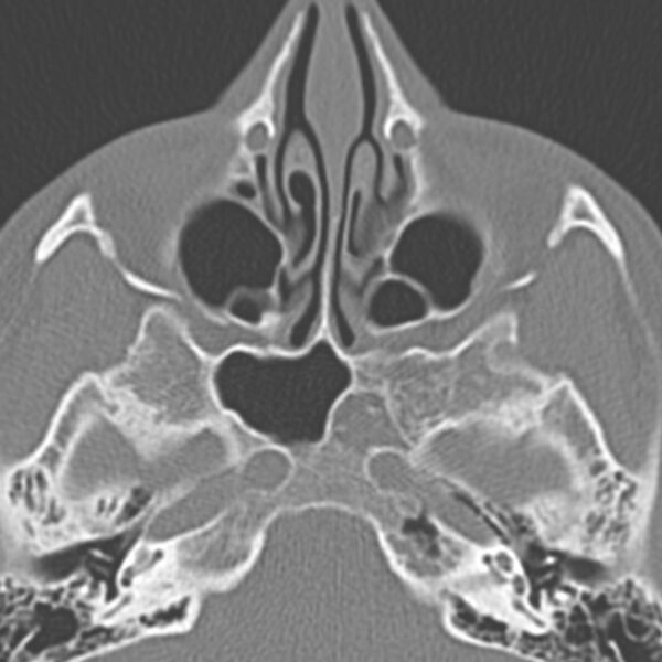 File:Arrested pneumatization of the sphenoid (Radiopaedia 10700-11172 Axial non-contrast 5).jpg