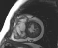 Arrhythmogenic right ventricular cardiomyopathy (Radiopaedia 69431-79307 Short axis cine 71).jpg