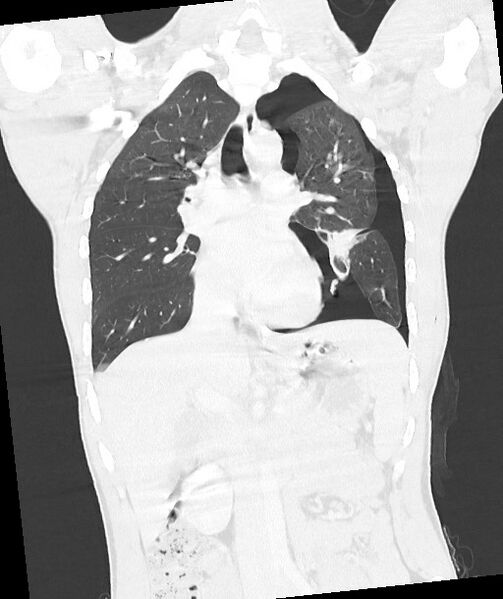 File:Arrow injury to the chest (Radiopaedia 85367-100975 Coronal lung window 74).jpg