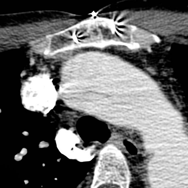 File:Arterial dissection into common carotid artery (Radiopaedia 8860).jpg