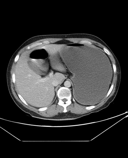 File:Arterial occlusive mesenteric ischemia (Radiopaedia 84641-100054 A 24).jpg