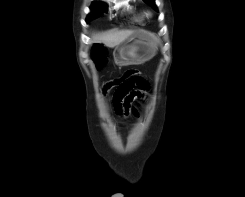 Arterial occlusive mesenteric ischemia (Radiopaedia 84641-100060 B 6).jpg