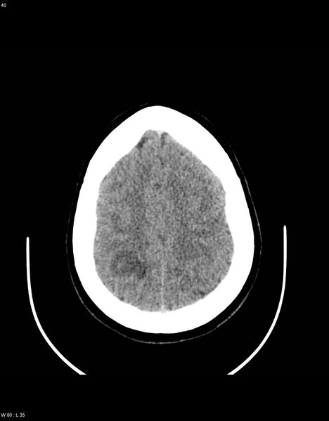 File:Astroblastoma (Radiopaedia 39792-42216 Axial non-contrast 39).jpg