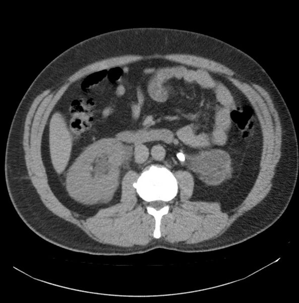 File:Atrophic kidney due to severe chronic obstructive hydronephrosis (Radiopaedia 40828-43474 Axial non-contrast 9).jpg
