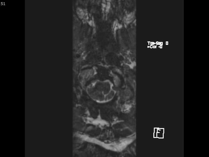 File:Atypical meningioma - intraosseous (Radiopaedia 64915-74572 Axial CISS 51).jpg