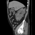 Autosomal dominant polycystic kidney disease (Radiopaedia 36539-38101 D 25).jpg