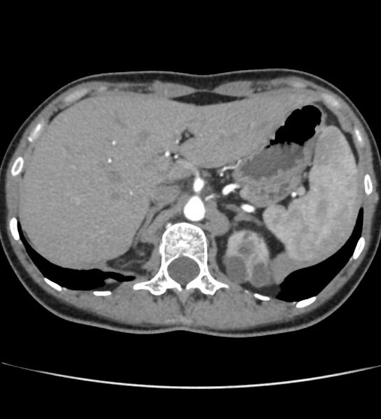 File:Autosomal dominant polycystic kidney disease - early onset (Radiopaedia 40734-43387 B 2).jpg