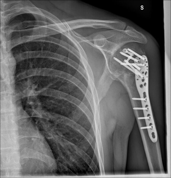 File:Avascular necrosis after fracture dislocations of the proximal humerus (Radiopaedia 88078-104652 Frontal 1).jpg