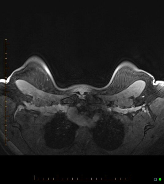 File:Axillary lymphadenopathy on breast MRI- yellow fever vaccination induced (Radiopaedia 19454-19483 Axial T1 C+ fat sat 7).jpg