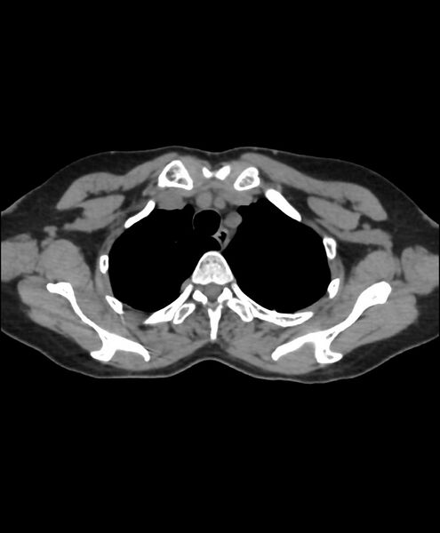 File:Azygos fissure and azygos lobe (Radiopaedia 41841-44832 Axial non-contrast 8).jpg
