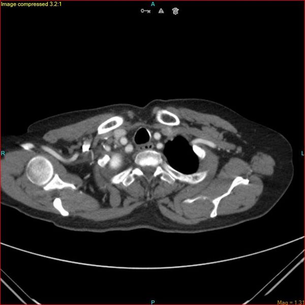 File:Azygos vein aneurysm (Radiopaedia 77824-90130 B 8).jpg