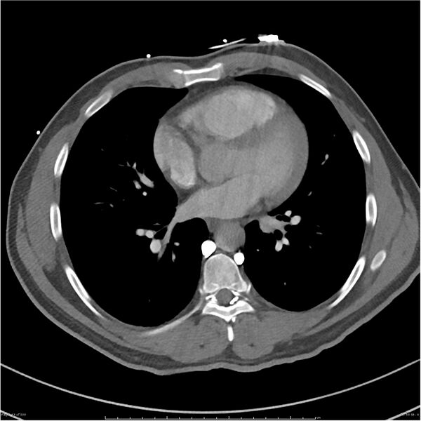File:Azygos venous system anatomy (CT pulmonary angiography) (Radiopaedia 25928-26077 Axial C+ CTPA 53).jpg