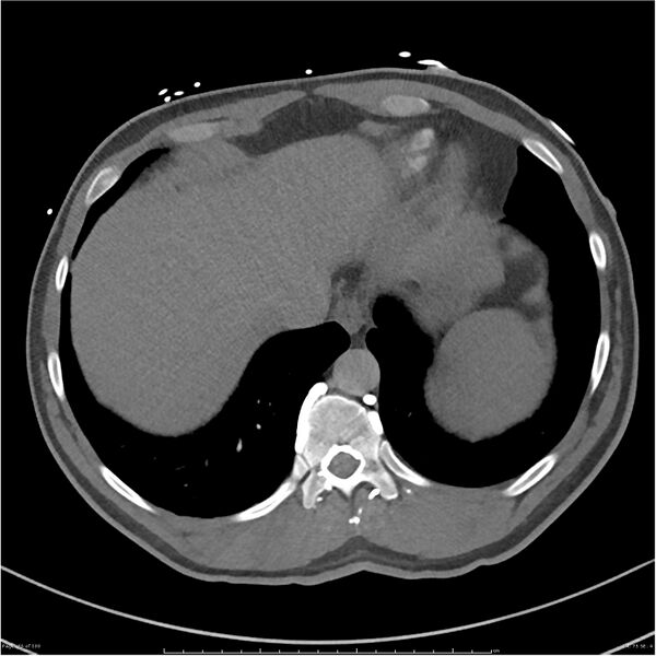 File:Azygos venous system anatomy (CT pulmonary angiography) (Radiopaedia 25928-26077 Axial C+ CTPA 75).jpg