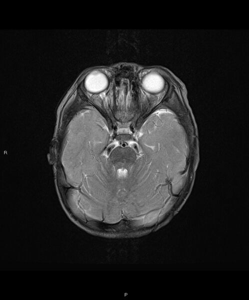 File:Basal ganglia and parenchymal ischemia (Radiopaedia 45818-50084 Axial T2 7).jpg