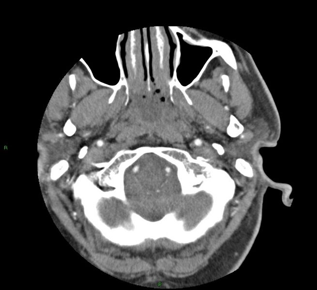 File:Basal ganglia hemorrhage (Radiopaedia 58763-65985 D 20).jpg