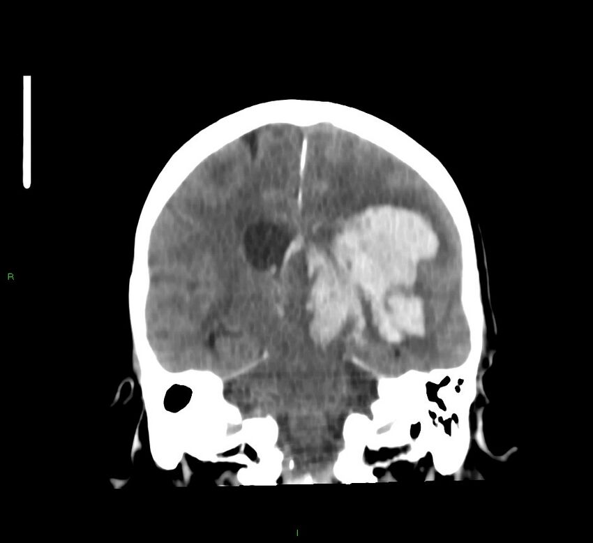 Basal ganglia hemorrhage (Radiopaedia 58767-65989 Coronal non-contrast 32).jpg