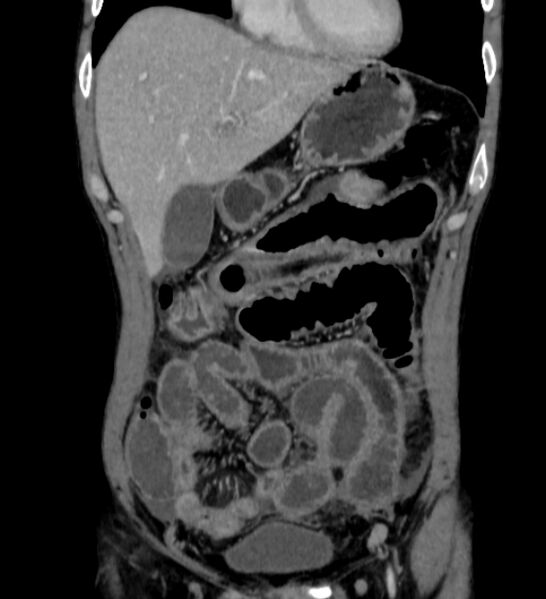 File:Behçet's disease- abdominal vasculitis (Radiopaedia 55955-62570 B 12).jpg