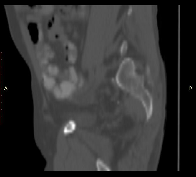 File:Bertolotti syndrome (Radiopaedia 58974-66235 Sagittal bone window 4).jpg