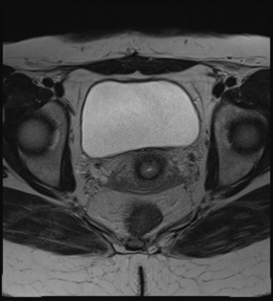File:Bicornuate, unicollis uterus (Radiopaedia 79468-92593 Axial T2 15).jpg