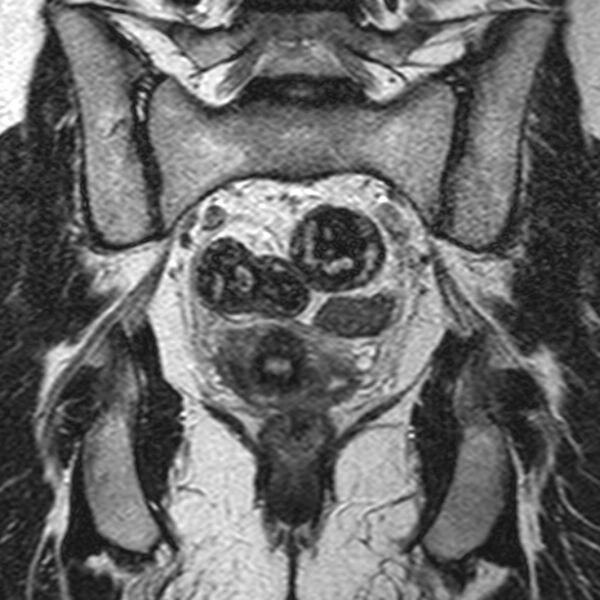 File:Bicornuate uterus (Radiopaedia 11104-11492 Coronal T2 19).jpg
