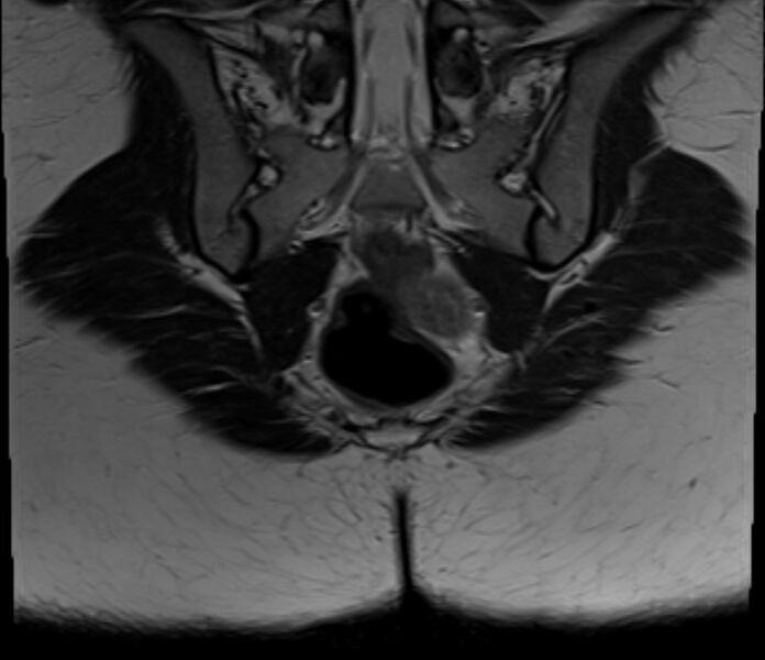 File:Bicornuate uterus (Radiopaedia 71214-81511 Coronal T2 3).jpg