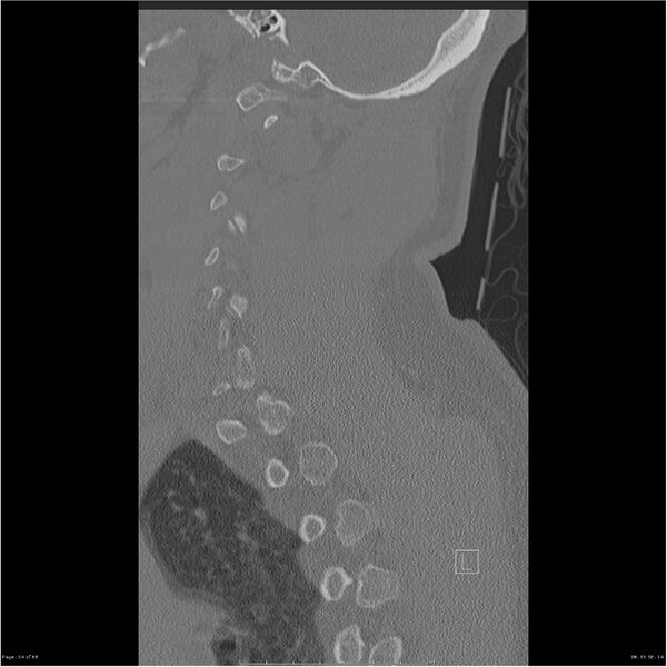 File:Bilateral cervical ribs (Radiopaedia 25868-26017 Sagittal bone window 54).jpg