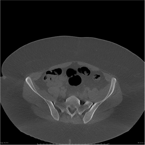File:Bilateral lumbar ribs (Radiopaedia 25862-26010 bone window 46).jpg