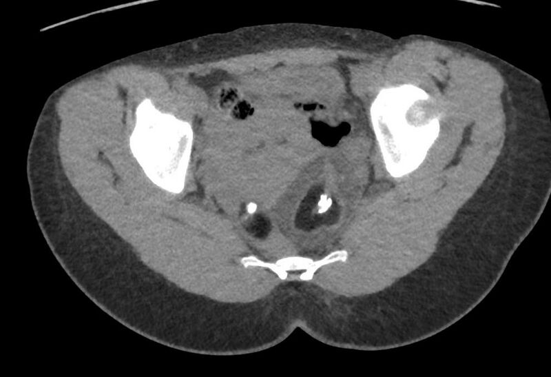 File:Bilateral mature cystic ovarian teratoma (Radiopaedia 88821-105592 Axial non-contrast 29).jpg