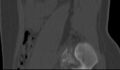Bilateral pars defect (Radiopaedia 26691-26846 Sagittal bone window 7).jpg