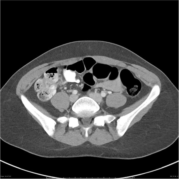 File:Bilateral ureteritis and cystitis (Radiopaedia 25340-25594 A 51).jpg