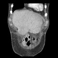 Biliary necrosis - liver transplant (Radiopaedia 21876-21846 C 4).jpg