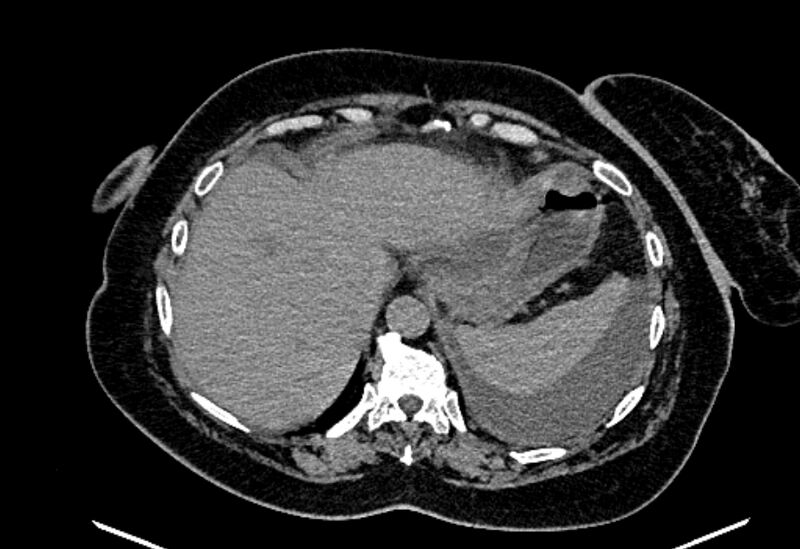 File:Biliary pancreatitis (Radiopaedia 72289-82823 Axial non-contrast 57).jpg