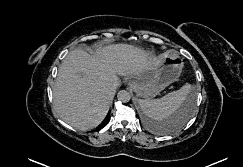 Biliary pancreatitis (Radiopaedia 72289-82823 Axial non-contrast 57).jpg