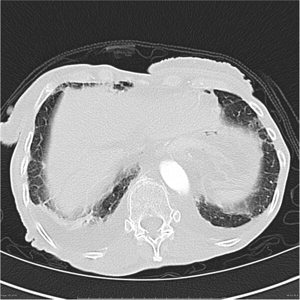 File:Boerhaave syndrome (Radiopaedia 26240-26362 Axial lung window 42).jpg