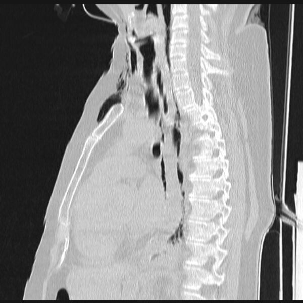 File:Boerhaave syndrome (Radiopaedia 45644-49799 Sagittal lung window 40).jpg