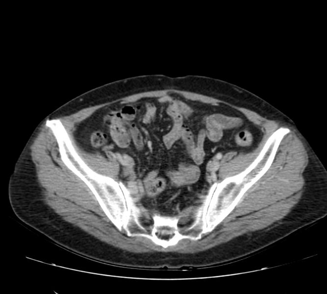 File:Bosniak renal cyst - type IV (Radiopaedia 22929-22953 C 53).jpg