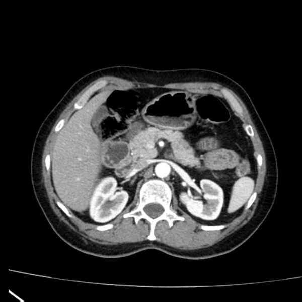 File:Bosniak renal cyst - type I (Radiopaedia 27479-27675 renal cortical phase 26).jpg