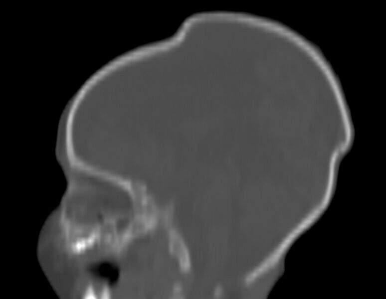 File:Brachycephaly (bi-coronal and bi-lambdoid synostosis) (Radiopaedia 55048-61413 Sagittal bone window 18).jpg