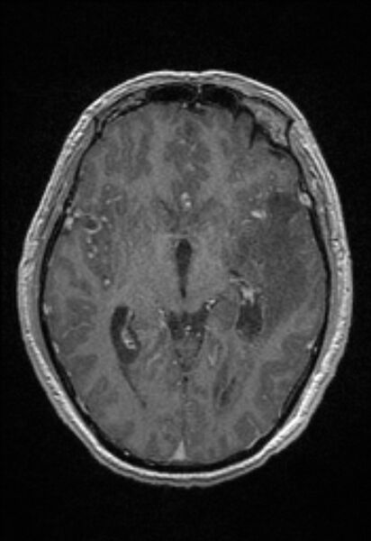 File:Brain abscess with ventriculitis (Radiopaedia 85703-101495 Axial T1 C+ 85).jpg