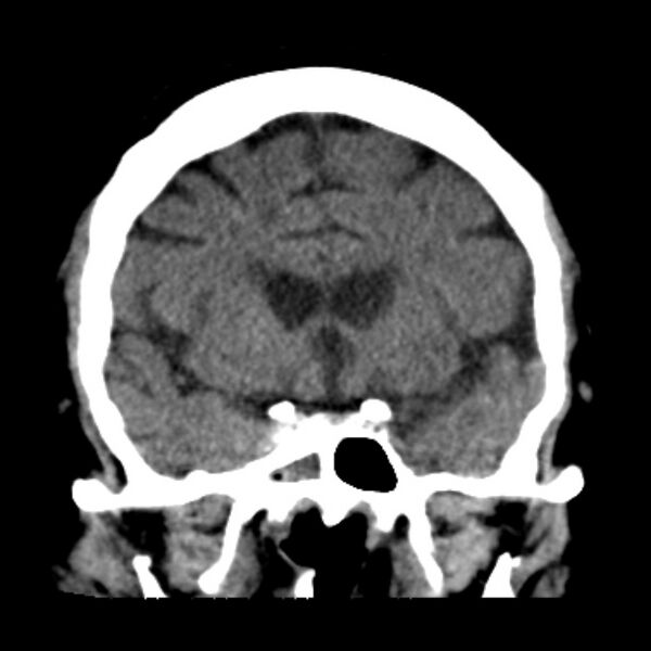 File:Brain cortical laminar necrosis (Radiopaedia 25822-25971 C 21).jpg