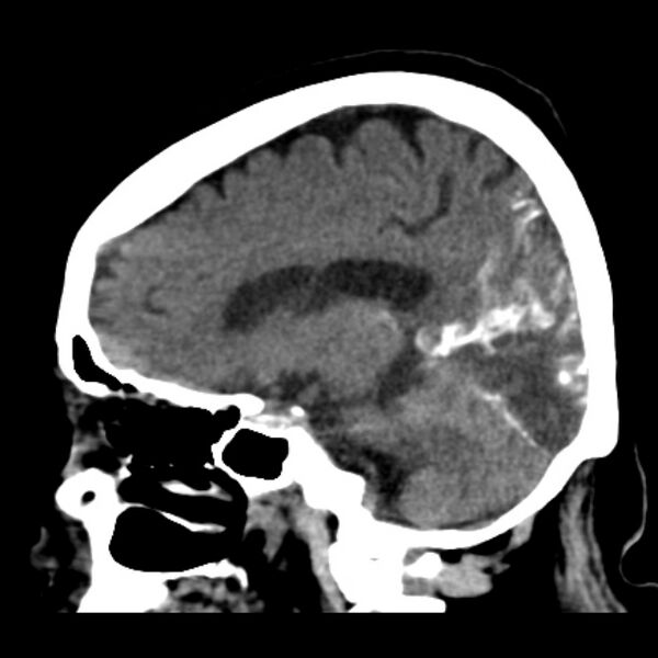 File:Brain cortical laminar necrosis (Radiopaedia 25822-25971 non-contrast 30).jpg