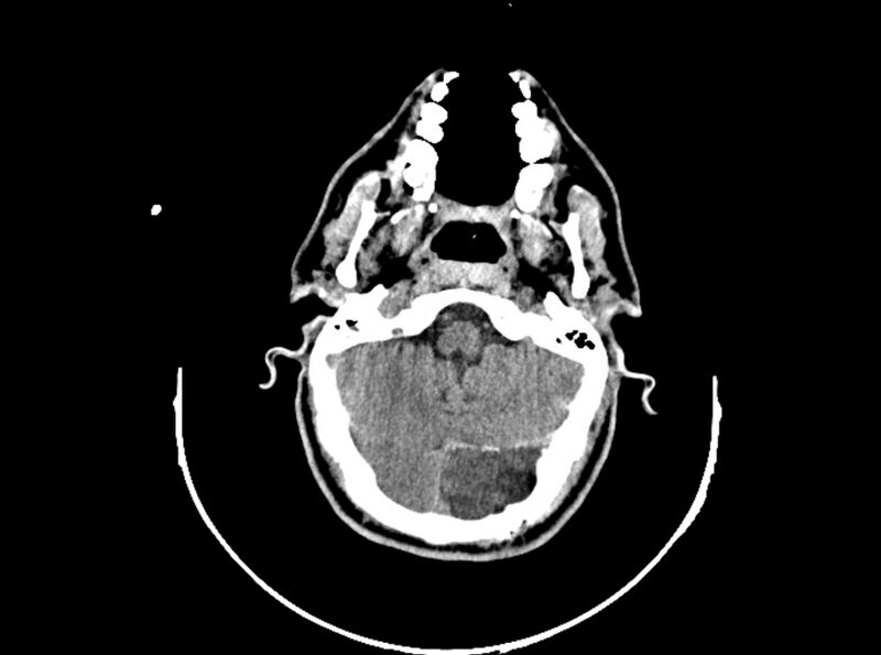 File:Brain injury by firearm projectile (Radiopaedia 82068-96088 A 74).jpg