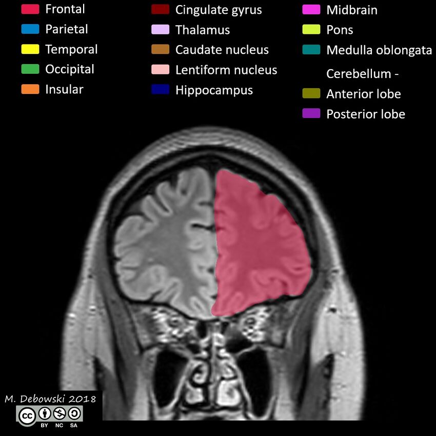 Brain lobes - annotated MRI (Radiopaedia 61691-69700 Coronal 14).JPG