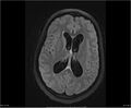Brainstem glioma (Radiopaedia 21819-21775 Axial FLAIR 23).jpg