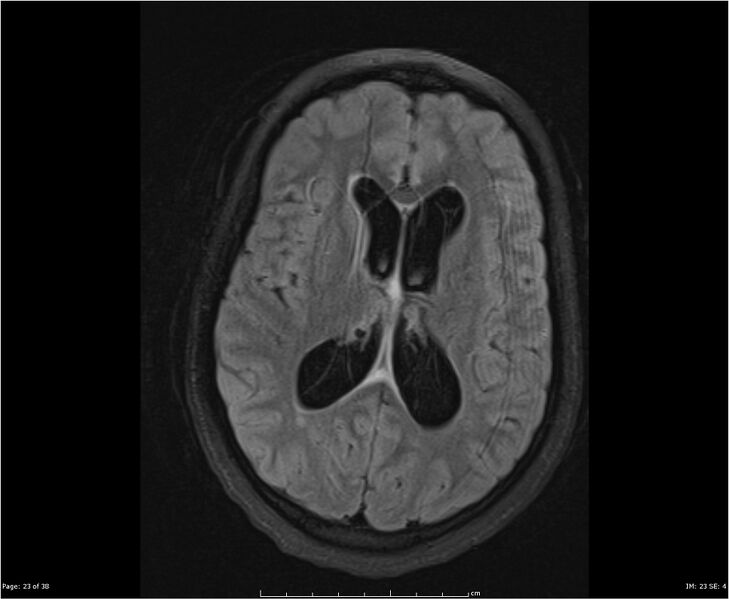 File:Brainstem glioma (Radiopaedia 21819-21775 Axial FLAIR 23).jpg