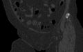 Breast carcinoma with pathological hip fracture (Radiopaedia 60314-67993 Coronal bone window 47).jpg