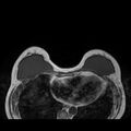 Breast implants - MRI (Radiopaedia 26864-27035 Axial T1 18).jpg