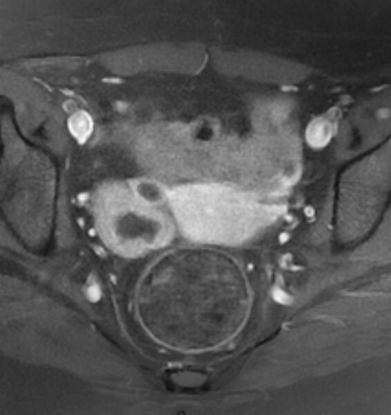 File:Broad ligament leiomyoma (Radiopaedia 81634-95516 Axial T1 C+ fat sat 14).jpg