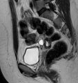Broad ligament leiomyoma (Radiopaedia 81634-95516 Sagittal T2 12).jpg